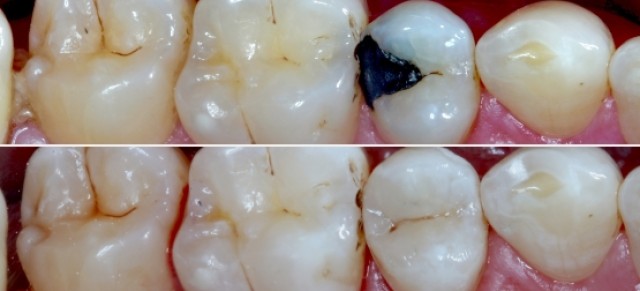 Closing the Class II Restoration Box, Part 1: Common Problems