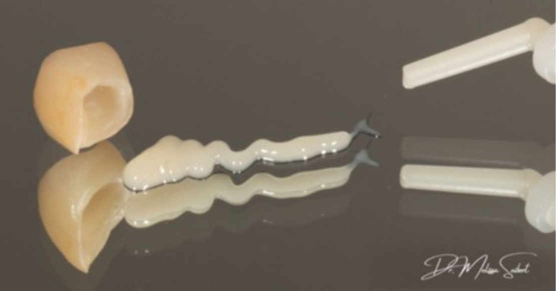 efrver Dental cement being dispensed into a crown before placement during an indirect restoration procedure