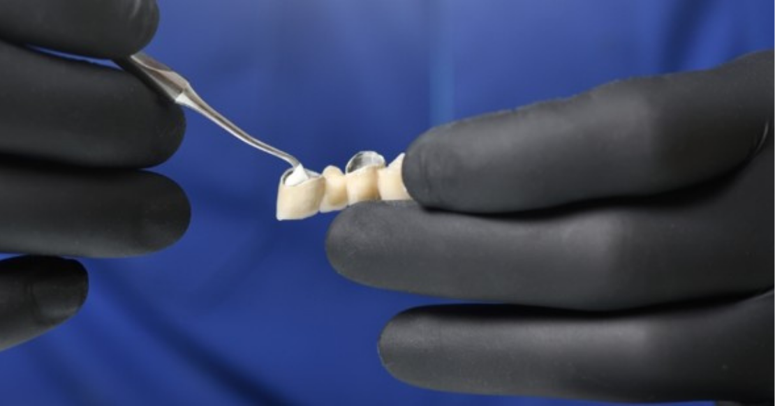 Cements Dentistry: Pros, Cons, and How to Choose Clinician applying dental cement to an indirect restoration during a crown cementation procedure in dentistry.