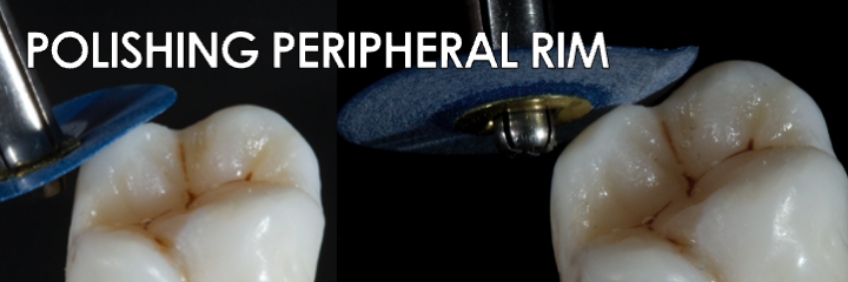 Finishing the Direct Posterior Composite Restoration: A Visual Essay Smithson finishing direct posterior composite 01