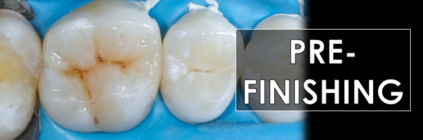 Finishing the Direct Posterior Composite Restoration: A Visual Essay Smithson finishing direct posterior composite 03