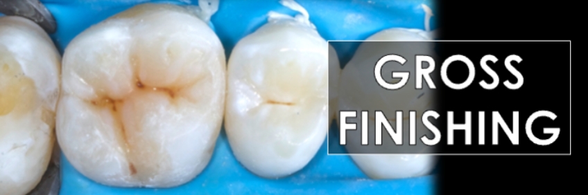 Finishing the Direct Posterior Composite Restoration: A Visual Essay Smithson finishing direct posterior composite 04