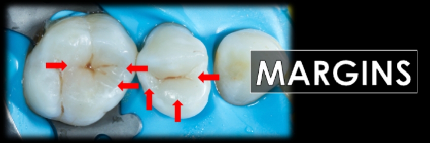 Finishing the Direct Posterior Composite Restoration: A Visual Essay Smithson finishing direct posterior composite 06