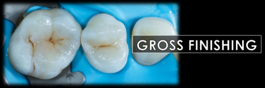 Finishing the Direct Posterior Composite Restoration: A Visual Essay Smithson finishing direct posterior composite 08