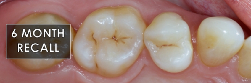 Finishing the Direct Posterior Composite Restoration: A Visual Essay Smithson finishing direct posterior composite 09