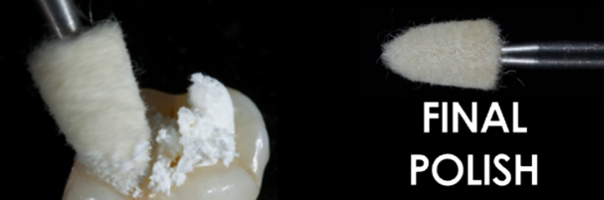 Finishing the Direct Posterior Composite Restoration: A Visual Essay Smithson finishing direct posterior composite 11