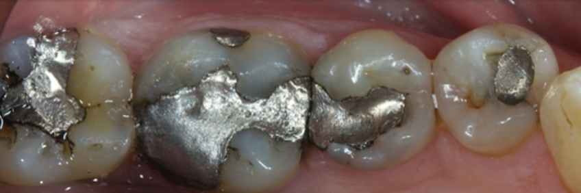 Finishing the Direct Posterior Composite Restoration: A Visual Essay Smithson finishing direct posterior composite 12