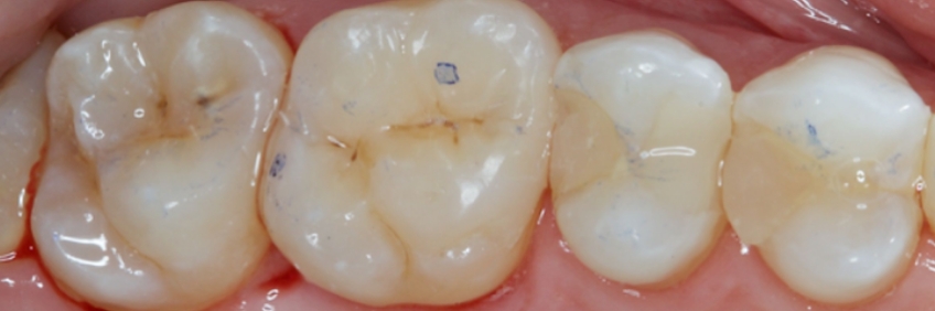 Finishing the Direct Posterior Composite Restoration: A Visual Essay Smithson finishing direct posterior composite 15 2