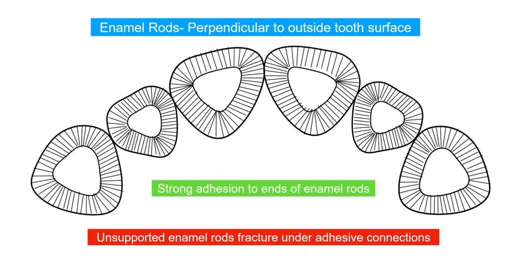 Enamel Rods: The Key to Successful Restorative Adhesion Bonk enamel rods successful adhesion 02