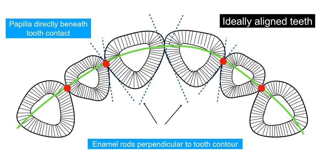 Enamel Rods: The Key to Successful Restorative Adhesion Bonk enamel rods successful adhesion 03