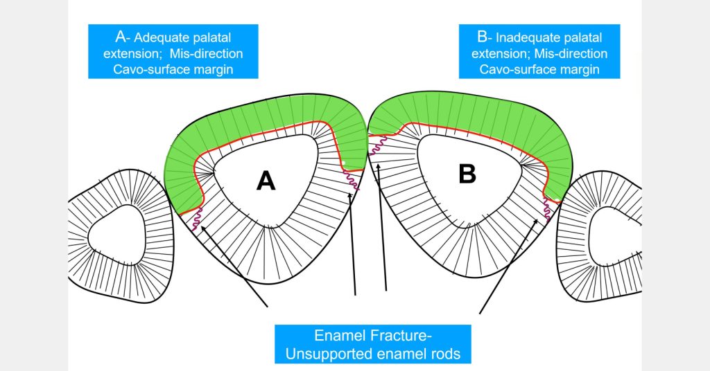 Enamel Rods: The Key to Successful Restorative Adhesion Bonk enamel rods successful adhesion 04
