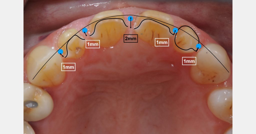 Enamel Rods: The Key to Successful Restorative Adhesion Bonk enamel rods successful adhesion 07