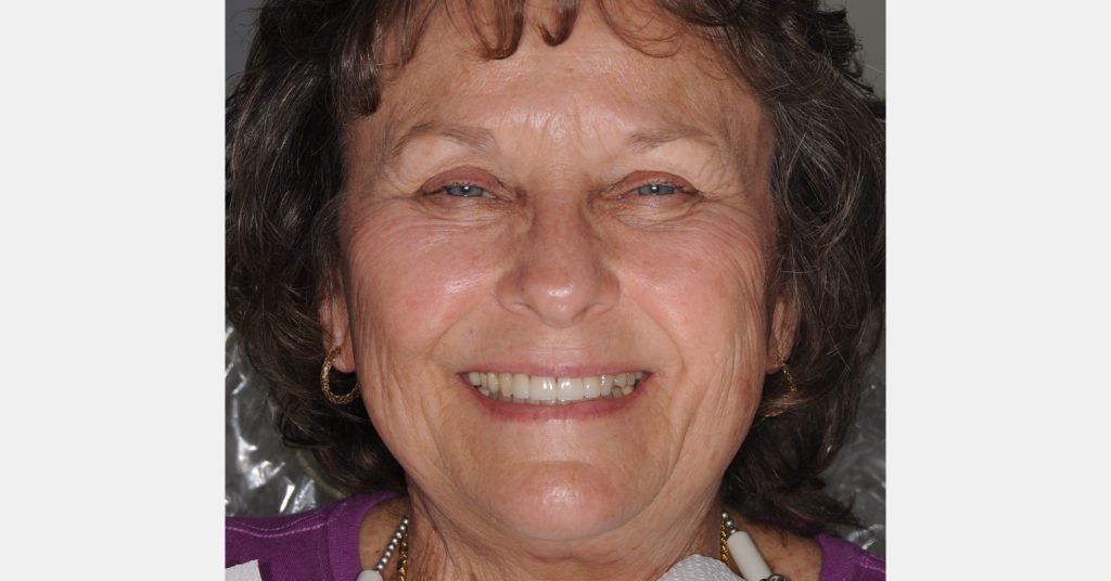 Enamel Rods: The Key to Successful Restorative Adhesion Bonk enamel rods successful adhesion 08