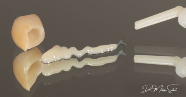 A Crash Course in Dental Cements for Restorative Procedures