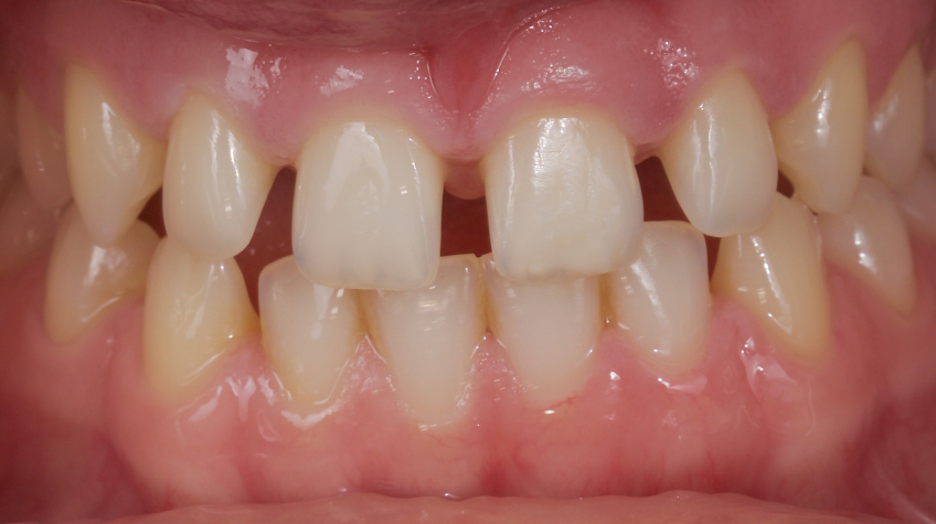 Managing the Midline Diastema, Part 1: Etiology Smithson managing midline diastema pt1 01 1