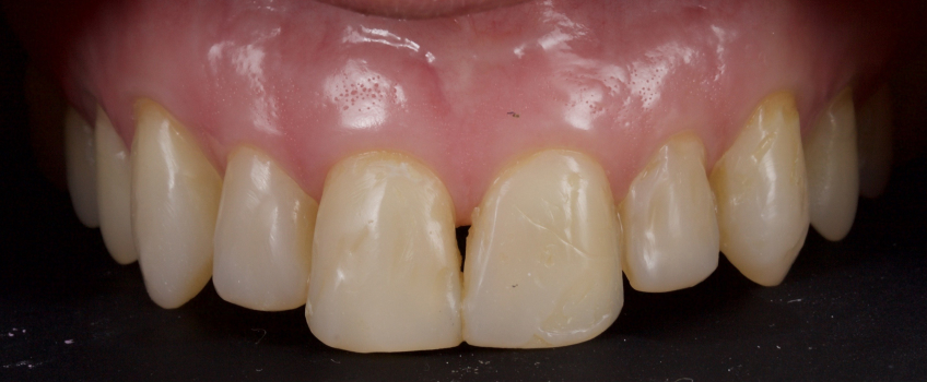Managing the Midline Diastema, Part 1: Etiology Smithson managing midline diastema pt1 02