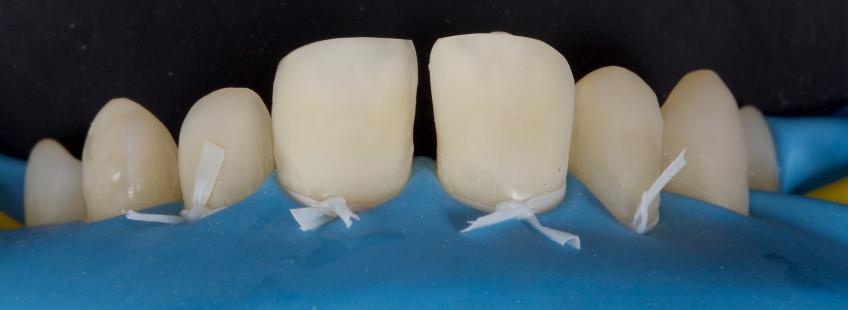 Managing the Midline Diastema, Part 1: Etiology Smithson managing midline diastema pt1 03