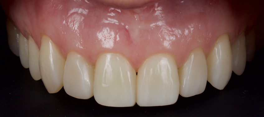 Managing the Midline Diastema, Part 1: Etiology Smithson managing midline diastema pt1 04
