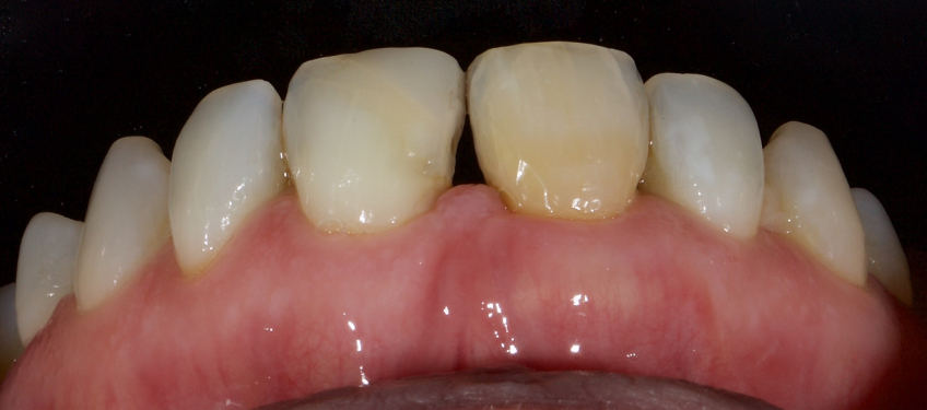 Managing the Midline Diastema, Part 1: Etiology Smithson managing midline diastema pt1 05