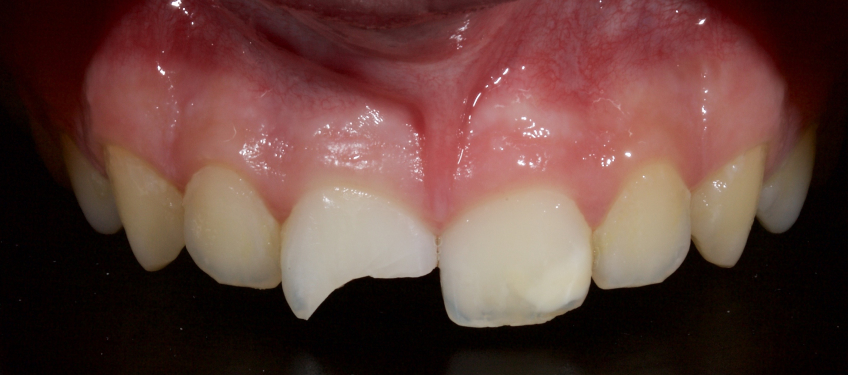 Managing the Midline Diastema, Part 1: Etiology Smithson managing midline diastema pt1 06