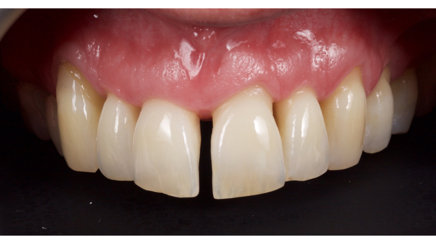 Managing the Midline Diastema, Part 1: Etiology Smithson managing midline diastema pt1 07