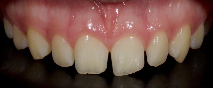 Managing the Midline Diastema, Part 1: Etiology Smithson managing midline diastema pt1 08