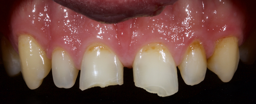 Managing the Midline Diastema, Part 1: Etiology Smithson managing midline diastema pt1 09