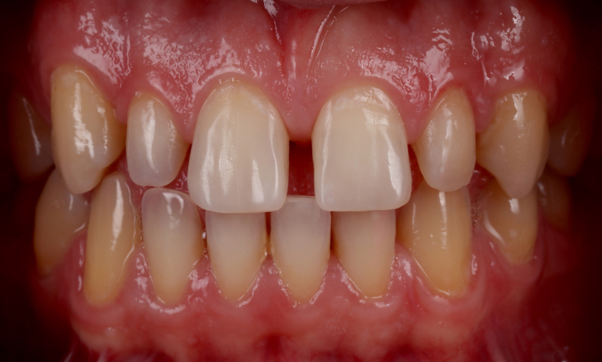 Managing the Midline Diastema, Part 1: Etiology Smithson managing midline diastema pt1 10