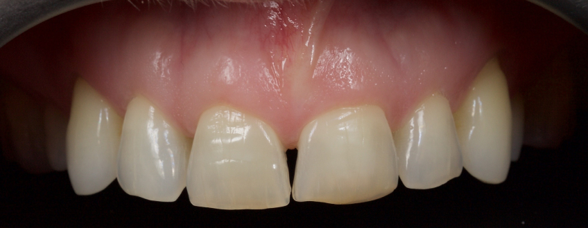 Managing the Midline Diastema, Part 1: Etiology Smithson managing midline diastema pt1 12