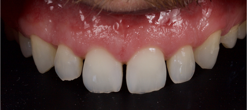 Managing the Midline Diastema, Part 1: Etiology Smithson managing midline diastema pt1 13