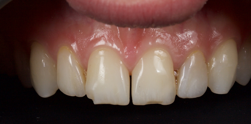 Managing the Midline Diastema, Part 1: Etiology Smithson managing midline diastema pt1 14
