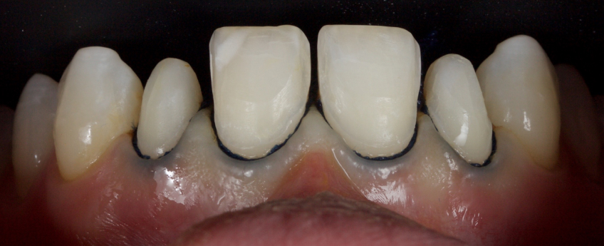 Managing the Midline Diastema, Part 1: Etiology Smithson managing midline diastema pt1 15