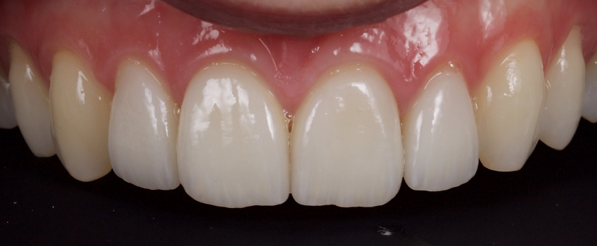 Managing the Midline Diastema, Part 1: Etiology Smithson managing midline diastema pt1 16 1