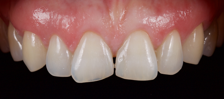 Managing the Midline Diastema, Part 1: Etiology Smithson managing midline diastema pt1 17