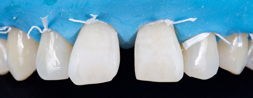 Managing the Midline Diastema, Part 1: Etiology Smithson managing midline diastema pt1 18
