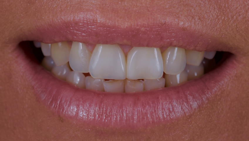 Managing the Midline Diastema, Part 1: Etiology Smithson managing midline diastema pt1 19