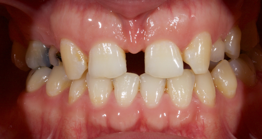 Managing the Midline Diastema, Part 1: Etiology Smithson managing midline diastema pt1 20