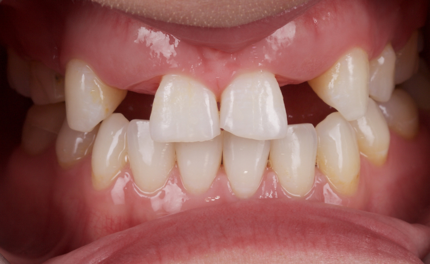 Managing the Midline Diastema, Part 1: Etiology Smithson managing midline diastema pt1 21