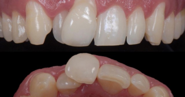 Spear Digest Ricardo Mitrado Battling the Dental Overtreatment Featured Image