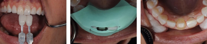 The Single Central Checklist in Anterior Tooth Restoration Jeffrey Bonk the single central checklist in anterior tooth restoration figure 2