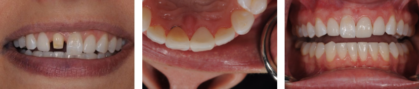 The Single Central Checklist in Anterior Tooth Restoration Jeffrey Bonk the single central checklist in anterior tooth restoration figure 5 7