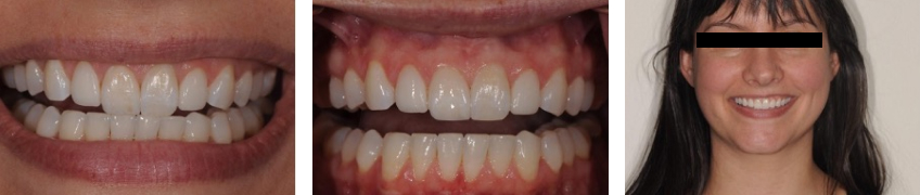 The Single Central Checklist in Anterior Tooth Restoration JeffreyBonk the Single Central Checklist Fig4