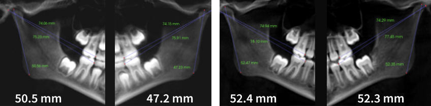 The Diagnosis-First Approach to Occlusal Splints Curt Ringhofer Diagnosis First Approach Fig2b