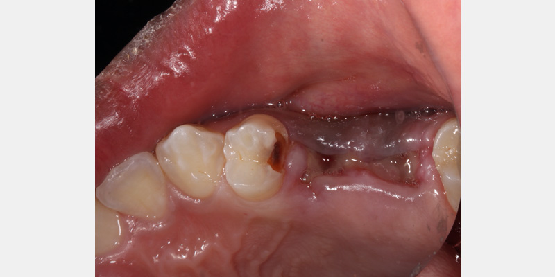 efrver Rubber dam isolation provides soft tissue retraction during anterior tooth preparation for a restorative procedure.