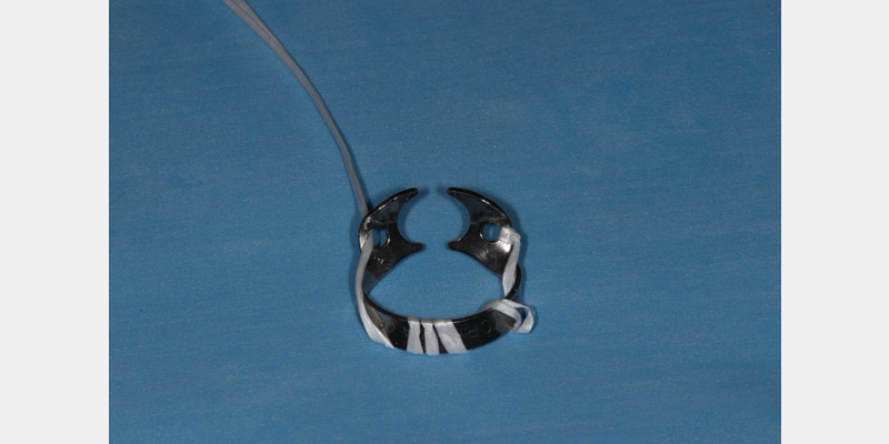 efrver Rubber dam clamp secured with dental floss ligature to reduce aspiration risk during placement.