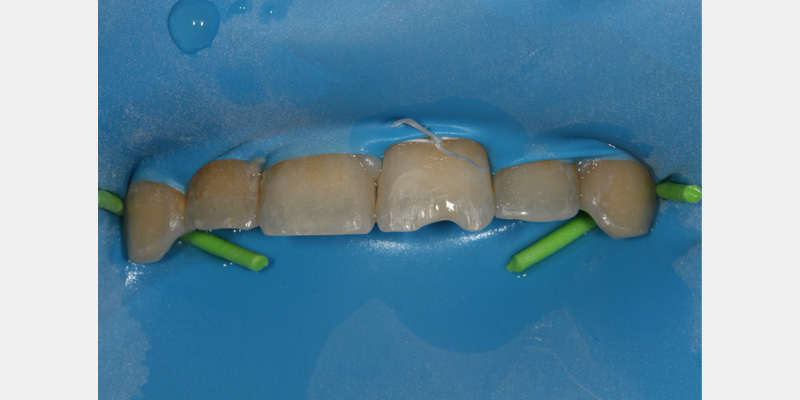 efrver Rubber dam isolation using floss ligatures to secure the dam and improve inversion around anterior teeth.