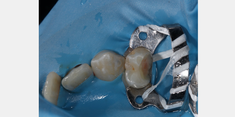efrver Rubber dam isolating teeth adjacent to a recent extraction site during restorative treatment.