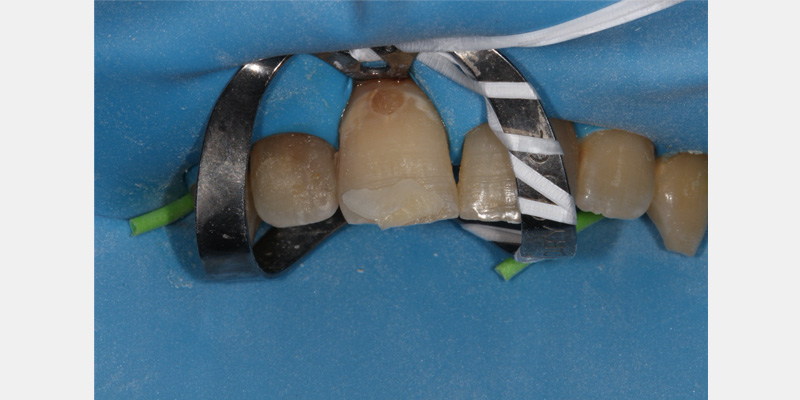 efrver Clinical view of a rubber dam isolating teeth for a restorative dental procedure.