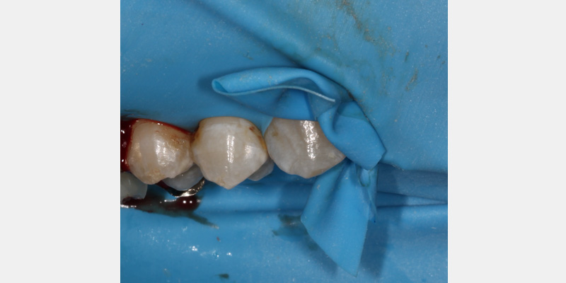 efrver Rubber dam secured with a Wedjet to improve isolation around teeth with open contacts.