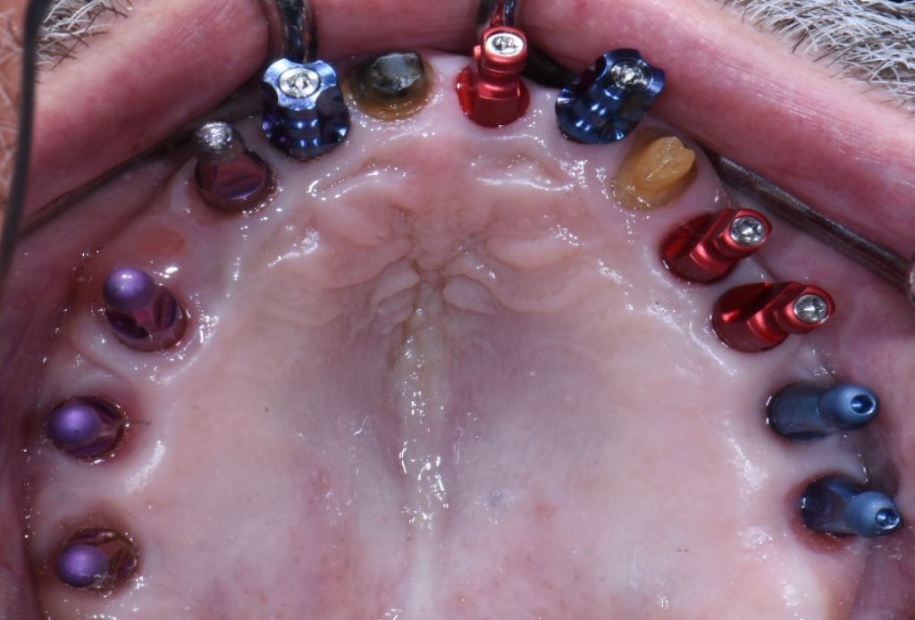 John Carson Taking Records for Day to Day Implant Restorations Figure 2